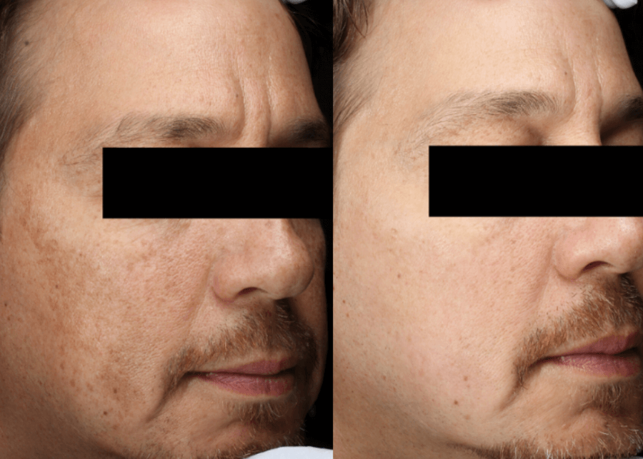 Case Study 2, JDD Before After